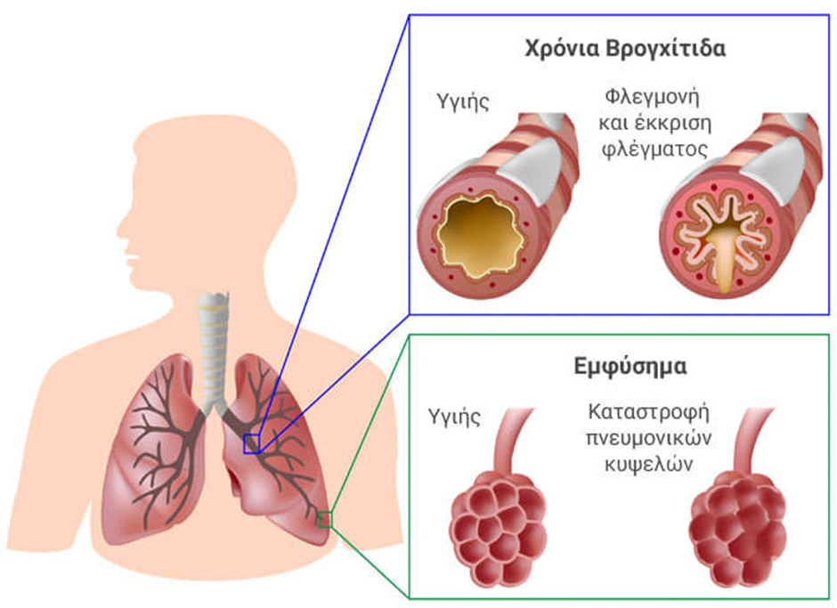 Ασθενής με ΧΑΠ