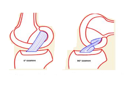 Η ΕΜΒΙΟΜΗΧΑΝΙΚΗ ΤΟΥ ΠΧΣ. Αριστερά οι ίνες του ΠΧΣ είναι παράλληλες μεταξύ τους (γόνατο σε πλήρη έκταση). Δεξιά οι ίνες του ΠΧΣ περιελίσσονται μεταξύ τους όταν το γόνατο κάνει κάμψη 90 μοιρών